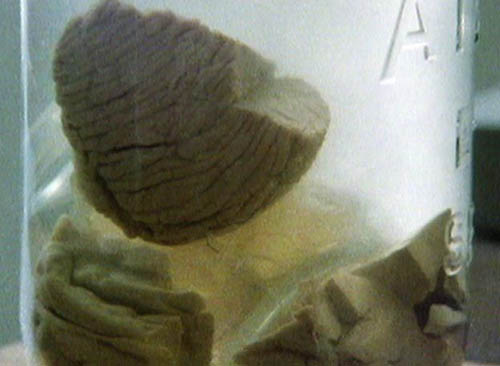 Một phần não của Albert Einstein trong lọ thủy tinh. Ảnh BBC