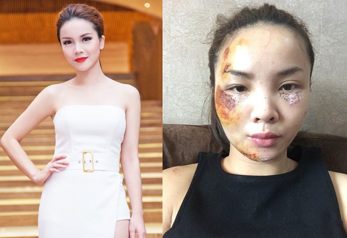 Gương mặt trầy nát của Yến Trang sau vụ tai nạn giao thông nghiêm trọng khiến người hâm mộ xót xa