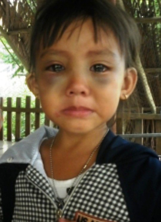 Bé gái 5 tuổi với khuôn mặt bầm tím, nghi là nạn nhân của việc bạo hành trẻ em dã man