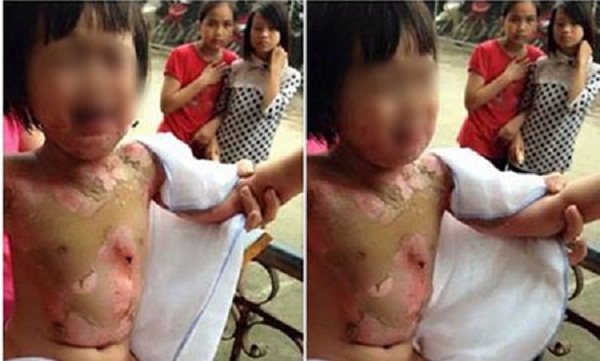 Do cô giáo mầm non không chú ý, bé gái 3 tuổi bị bạn đốt bỏng khắp người do 