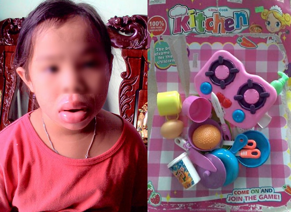 Bé gái bị dị ứng, biến dạng môi do chơi, ngậm đồ chơi Trung Quốc kém chất lượng