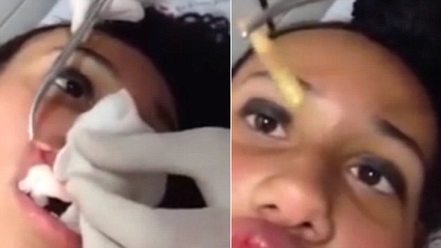 Cảnh bác sĩ gắp giòi từ môi cô gái bị bệnh lạ khiến người xem rùng mình