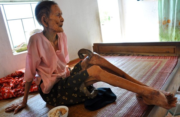 Ở Việt Nam cũng từng có câu chuyện lạ có thật về một bà cụ mọc sừng ở đầu gối vì bệnh sừng da