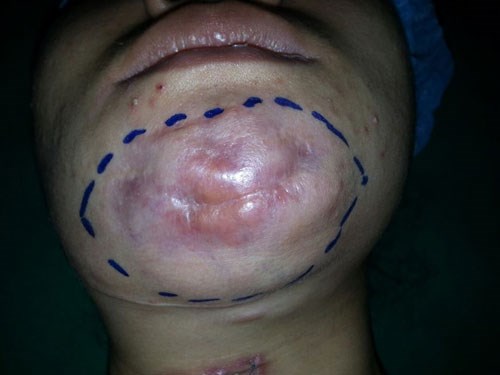 Vùng cằm của bệnh nhân bị nhiễm trùng nghiêm trọng do bơm silicon lỏng vào người