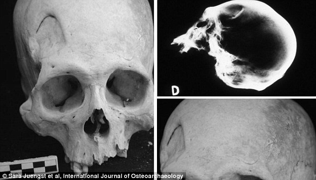 Các nhà khảo cổ học phát hiện bộ xương cổ đại cho thấy nhiều dấu hiệu của việc phẫu thuật não từ thời nguyên thủy