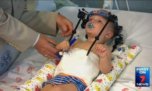Các bác sĩ Australia đã nối đầu cổ bé, cứu sống đứa trẻ trong ca mổ được miêu tả là 