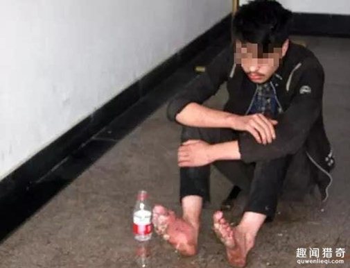 Đôi chân của Chen bị phồng rộp vì nắng nóng và đang dần thối rữa. Ảnh: People Daily