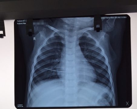 Hình ảnh chụp X-quang chiếc kim trong lồng ngực bé gái 3 tuổi. Ảnh: BVCC Hình ảnh chụp X-quang chiếc kim trong lồng ngực bé gái 3 tuổi. Ảnh: BVCC 
