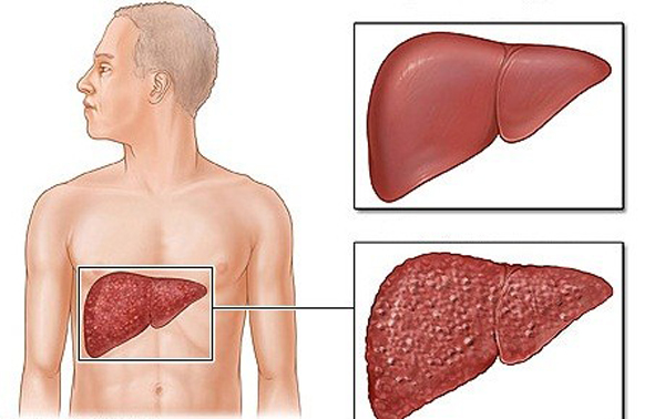 Cảnh báo những loại thuốc gây tổn thương gan