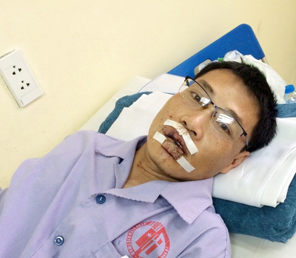 Anh Quang bị chấn thương phần mềm, dập môi và khâu nhiều mũi 