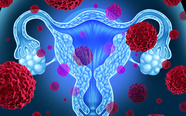 Ung thư buồng trứng: “sát thủ thầm lặng” của phụ nữ