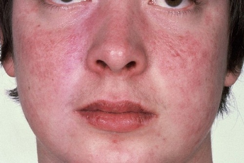 Những dấu hiệu của bệnh lupus ban đỏ bạn cần lưu ý