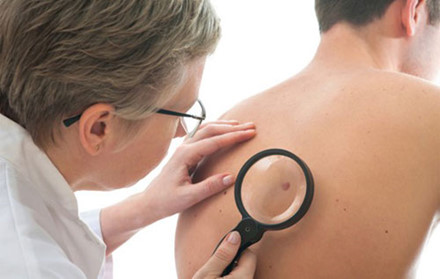 Mụn cóc, nhiều vết chàm, nốt ruồi hoặc sắc tố đều là những dấu hiệu của bệnh ung thư da. 