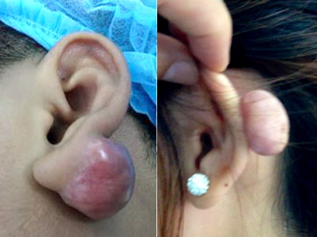 bấm lỗ tai gây hại