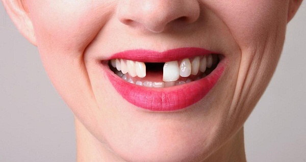 Ham rẻ làm răng sứ kém chất lượng cẩn thận hỏng cả hàm răng
