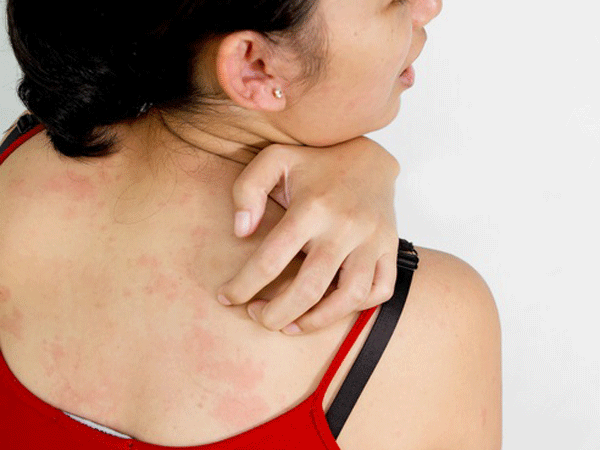 Ngứa da có thể là biểu hiện của nhiều bệnh nguy hiểm