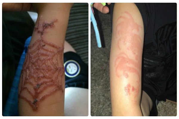 Một bà mẹ cảnh báo về xăm henna đen sau khi 2 con trai gặp họa khủng khiếp