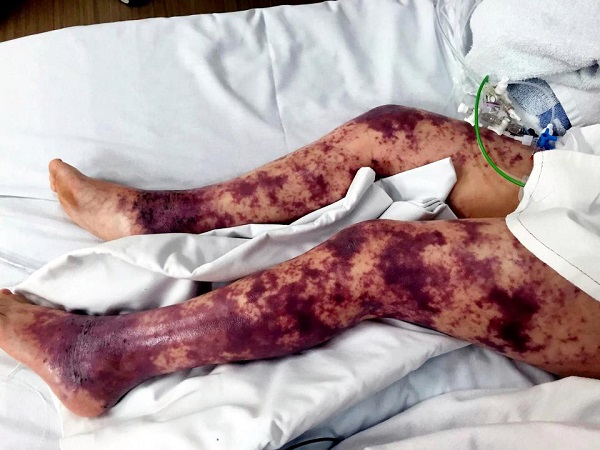 Cô bé mất cả hai chân vì nhiễm vi khuẩn nguy hiểm sau khi bơi lội trên biển