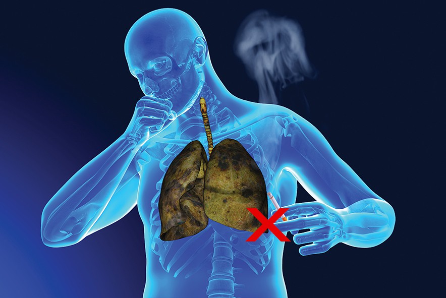 Ung thư phổi: 4 mẹo ngăn ngừa siêu đơn giản không phải ai cũng biết