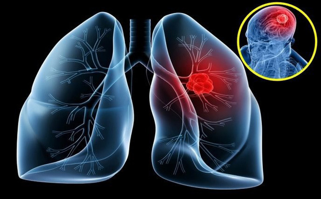 Ung thư phổi: 7 nguyên nhân gây bệnh ít người ngờ tới