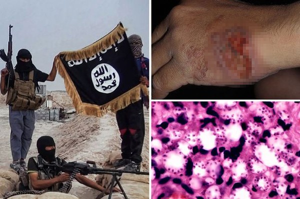 Dịch bệnh lây lan trong hàng ngũ phiến quân IS