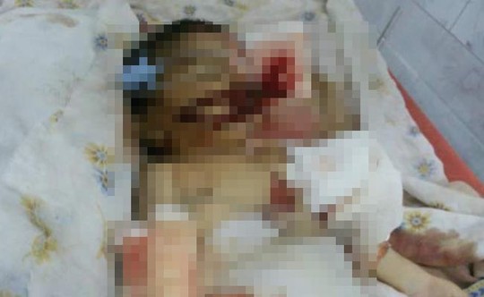 Một vụ tai nạn hy hữu tương tự khiến bé 10 ngày tuổi bị chuột cắn chết từng xảy ra trong bệnh viện ở Ấn Độ