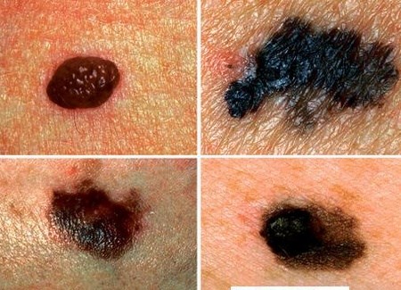 Nhiễm virus HPV cũng là nguyên nhân gây nên ung thư da