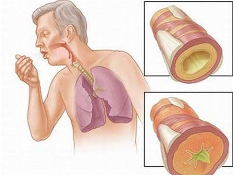 Một trong những dấu hiệu đáng chú ý của bệnh ung thư phổi là ho dai dẳng