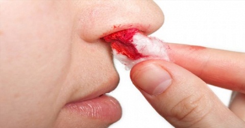 Dấu hiệu cho biết nguy cơ mắc ung thư vòm họng là hay chảy máu cam