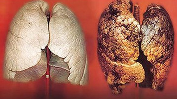 Ung thư phổi còn do tính chất công việc khi hít phải nhiều loại khí có hại