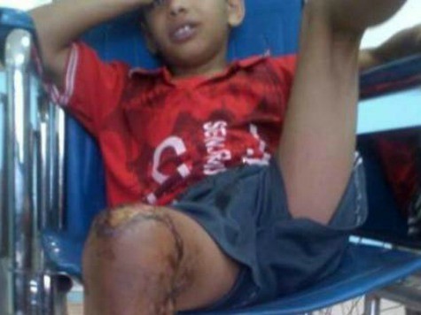 Cậu bé 10 tuổi người Yemen bị bỏng một chân sau trò đùa của một nhóm thiếu niên trong làng