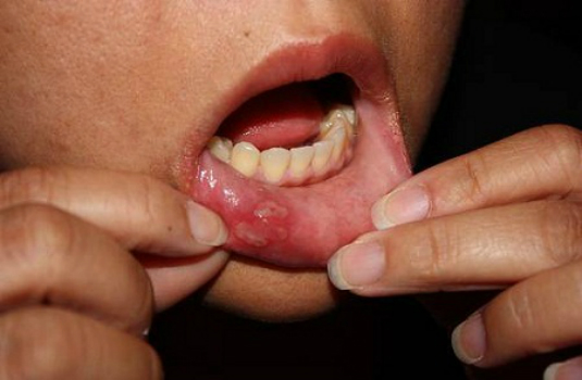 Nhiệt miệng rất có thể là biểu hiện của ung thư lưỡi