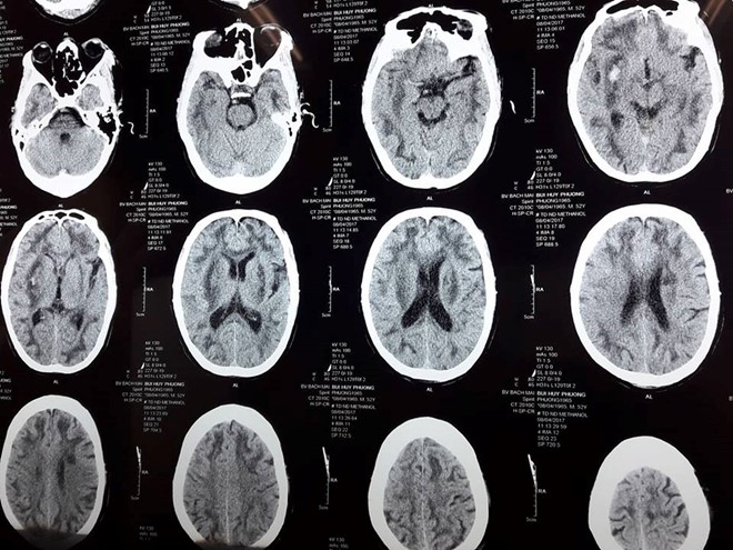 Hình ảnh chụp não bị tổn thương của nạn nhân ngộ độc rượu có methanol. Ảnh: Tri thức trực tuyến