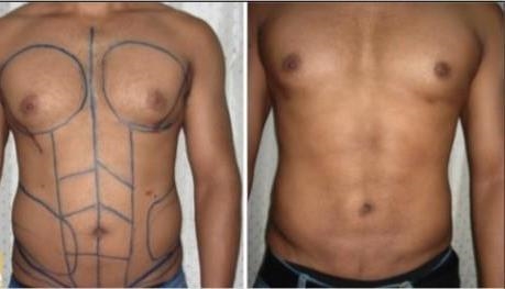 Phẫu thuật nâng ngực và tạo múi bụng cho nam giới