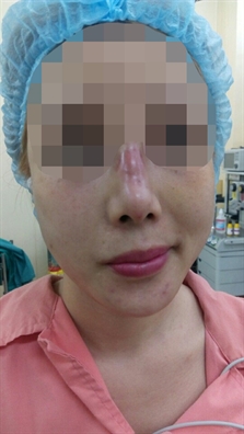 Sau khi nâng mũi, chiếc mũi của chị T. bị nhiễm trùng