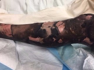 Chân của anh Sean Ritz hoàn toàn biến dạng sau khi chiếc thuốc lá điện tử bốc cháy