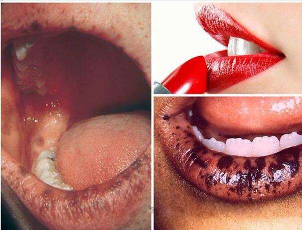 Đôi môi có thể chuyền màu đen xám vì ngộ độc chì từ son môi