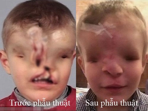 Khuôn mặt trước và sau phẫu thuật của em bé dị dạng Yahya