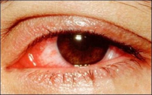 Bệnh đau mắt đỏ dễ lây lan do gió