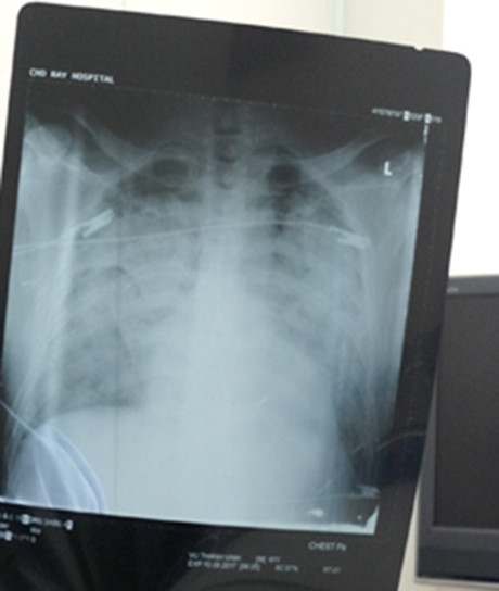 Tấm phim chụp phổi của bệnh nhân. Ảnh: Dân trí