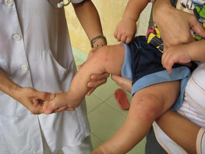  Trẻ bị bệnh chân tay miệng thường bị sốt cao