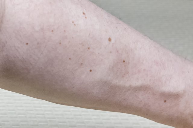 Theo các chuyên gia, số lượng nốt ruồi trên một cánh tay phải có ý nghĩa quan trọng trong việc chẩn đoán ung thư da. Ảnh minh họa