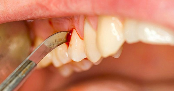 Các nhà nghiên cứu đã tìm thấy mối liên hệ giữa sức khỏe răng miệng kém và một số loại ung thư. Ảnh minh họa