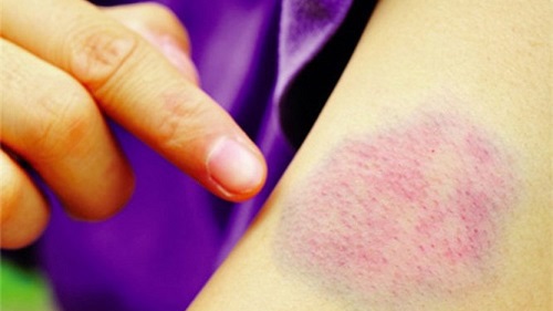Những dấu hiệu xuất huyết dưới da hay vết bầm tím có thể là do người bệnh mắc phải chứng xuất huyết giảm tiểu cầu miễn dịch. Ảnh minh họa