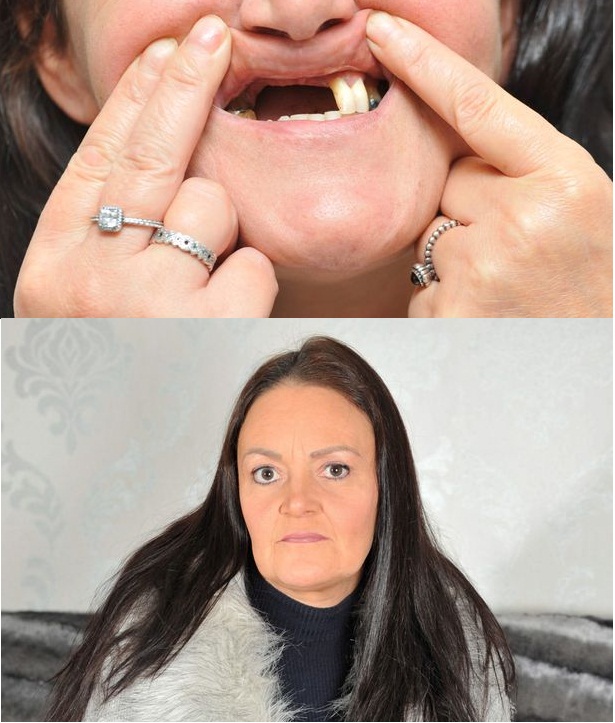 Làm trắng răng không thành, bà mẹ còn bị nha sỹ làm rụng mất đôi răng cửa