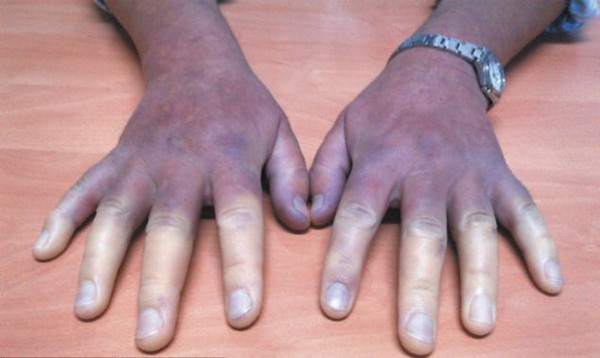 Bàn tay của người phụ nữ khi nhiễm bệnh