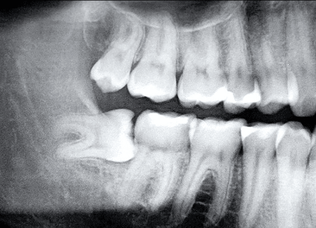 Chuyên gia tiết lộ sự thật kinh hoàng: Tử vong vì chiếc răng khôn, chớ coi thường!