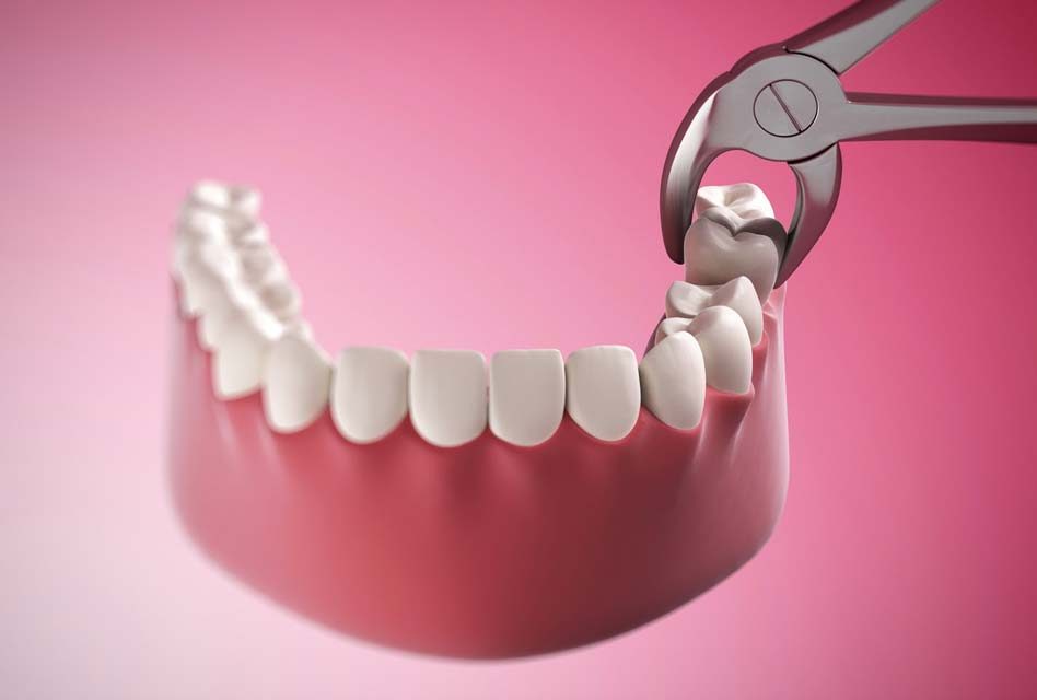 Chuyên gia tiết lộ sự thật kinh hoàng: Tử vong vì chiếc răng khôn, chớ coi thường!
