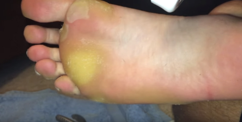 Đừng coi thường vết chai chân vì nó có thể đang cảnh báo bệnh nguy hiểm!