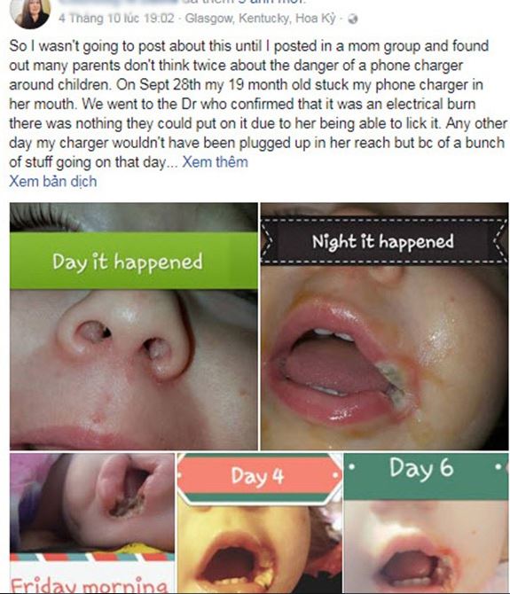 Bé gái 19 tháng tuổi bỏng nặng vì thói quen dùng điện thoại hầu như gia đình nào cũng mắc phải